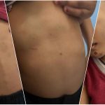 Anak Usia 6 Tahun di Sangihe, Diduga Dianiaya Ayah Tirinya