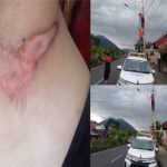 Terjerat Kabel yang Menjuntai di Jalan, Leher Seorang Jurnalis Terluka Hingga Terkelupas